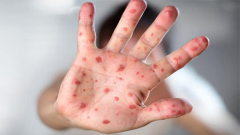 ما هي الحصبة، ولماذا ترجع إلى عالمنا الأن؟