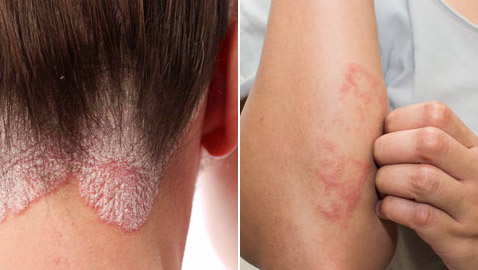 هل تعرف الفرق بين مرض الأكزيما والصدفية؟