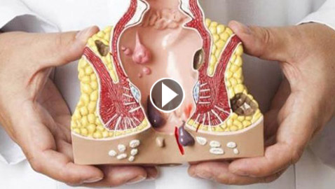 كيف تحصل البواسير وكيفية علاجها؟!