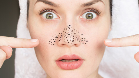 أفضل الخلطات الطبيعية لإزالة الرؤوس السوداء والتخلص منها