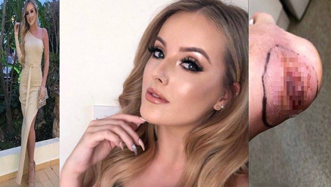 عارضة ازياء شهيرة تواجه خطر بتر قدمها بسبب حذاء... وهذه التفاصيل