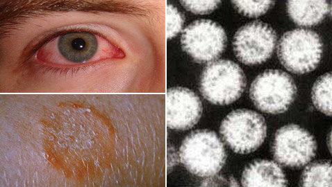 5 أنواع عدوى شائعة يتمنى العالم زوالها إلى الأبد