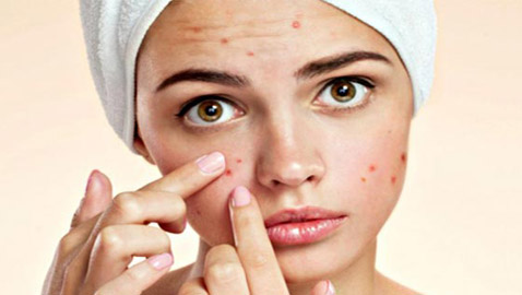 هل تعانون من حب الشباب؟.. هذه الأطعمة تكافحه