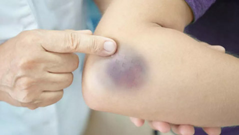 ما أسباب ظهور كدمات الجسم دون سبب؟