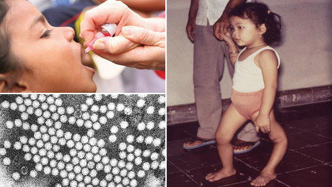 في اليوم العالمي لشلل الأطفال.. مسؤولو الصحة يعلنون انتصارا في مكافحته