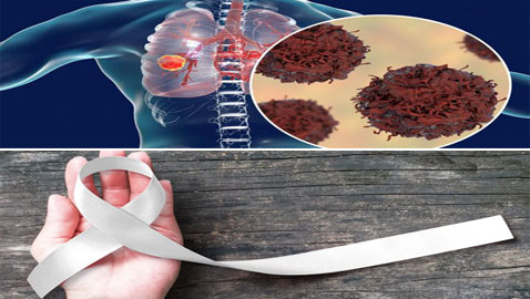 4 عادات سيئة تؤدي للإصابة بسرطان الرئة