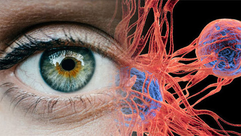 سرطان العين.. أسبابه، أعراضه وطرق اكتشافه ومعالجته