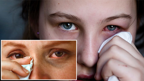 إنفلونزا العيون.. طرق الوقاية والتغلب على الأعراض المزعجة