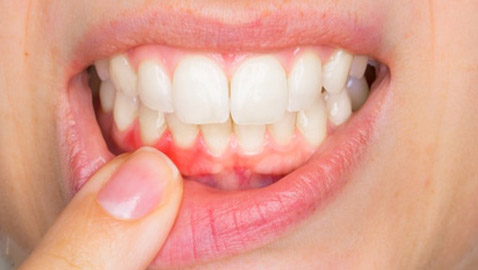 احذروا.. ربما تفقدون أسنانكم بسبب التهاب اللثة!!