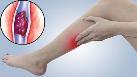 تعرفوا إلى أسباب حدوث جلطات الأوردة العميقة.. بعضها غير متوقع!