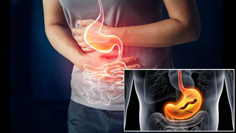 هل جرثومة المعدة قاتلة؟ تعرف على عوارضها وكيفية التخلص منها نهائيا