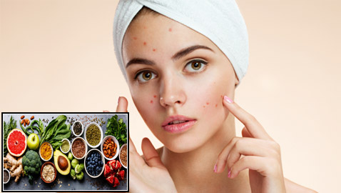 نصائح غذائية للقضاء على حب الشباب.. تعرف عليها!