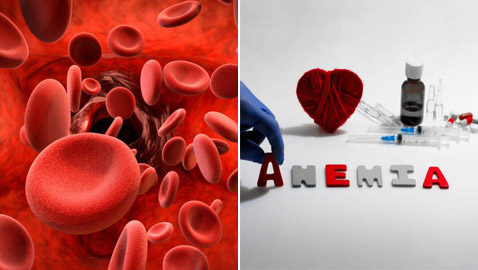 فقر الدم.. تعرفوا إلى طرق الوقاية والعلاج