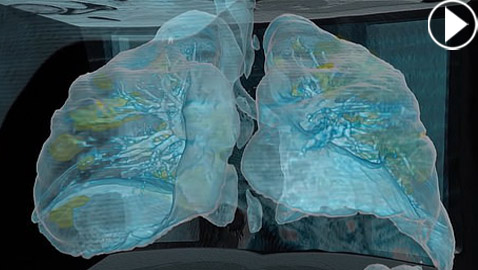 بالفيديو.. كيف تبدو رئة مصاب بفيروس كورونا وما يحصل داخلها؟