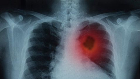 5 أطعمة لتعزيز صحة الجهاز التنفسي والرئتين