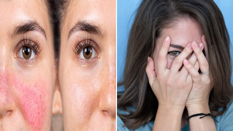 إليكم 11 طريقة للتخلص من مشكلة احمرار الوجه في المواقف المحرجة!