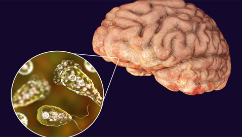 يصيب الدماغ ويدمره.. رصد أولى حالات لمرض خطير والأطباء بحالة رعب