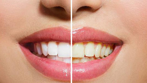 طرق طبيعية للتخلّص من اصفرار الأسنان