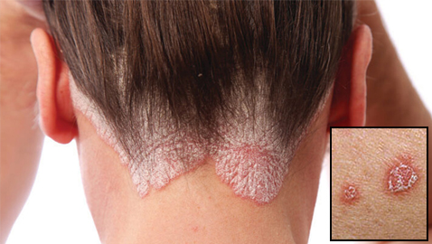 تعرفوا على أسباب الصدفية، أنواعها وأعراضها، طرق علاجها ومضاعفاتها