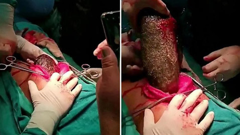 أطباء يسحبون كتلة شعر ضخمة بوزن 7 كغ من معدة فتاة!