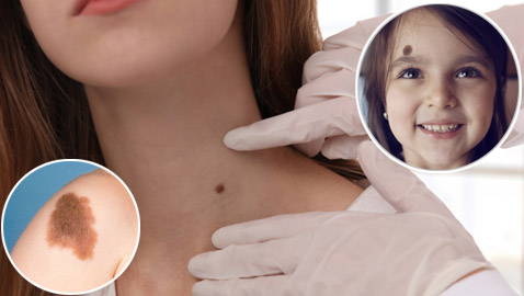 ارتبطت بها الخرافات والأساطير.. إليكم كل ما يخبرنا به العلم عن الوحمات