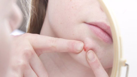 الأمر قد يبدو مقززا.. لكن هل فرقعة البثور وحب الشباب مضرة للجلد حقا؟