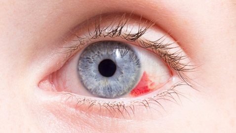 بقعة دم حمراء ظهرت في عينك فجأة؟ إلى ماذا تشير وما أسبابها وعلاجها؟
