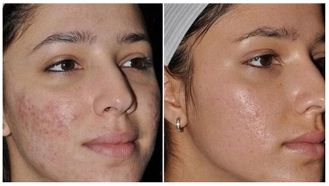 حُفر الوجه.. أسبابها وطرق علاجها والوقاية منها!